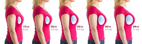 Breast Augmentation: 5 Before & After Photos That Prove The。